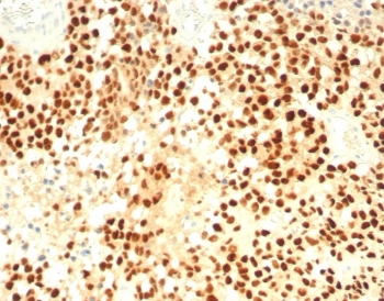 Steroidogenic Factor 1 Antibody Adrenal Cortex IHC. Immunohistochemistry analysis of FFPE human adrenal cortex tissue stained with Steroidogenic Factor 1 Antibody demonstrates strong diffuse nuclear HRP-DAB brown staining throughout adrenal cortical cellular populations, consistent with expression of steroidogenic factor 1 / NR5A1 in steroid-producing endocrine tissue compartments. This steroidogenic transcription factor antibody highlights nuclear localization patterns associated with adrenal differentiation, steroid hormone biosynthesis, and endocrine-associated transcriptional regulation pathways. HIER: boil tissue sections in pH 9 10mM Tris with 1mM EDTA for 20 min and allow to cool before testing.