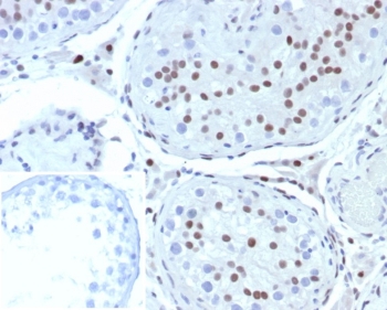 Steroidogenic Factor 1 Antibody Testis IHC. Immunohistochemistry analysis of FFPE human testis tissue stained with Steroidogenic Factor 1 Antibody demonstrates distinct nuclear HRP-DAB brown staining within seminiferous tubule-associated cellular populations, consistent with expression of steroidogenic factor 1 / NR5A1 in gonadal and endocrine-associated transcriptionally active compartments. This steroidogenic transcription factor antibody highlights nuclear localization patterns associated with reproductive tissue differentiation and steroidogenic signaling pathways. Inset: PBS was used in place of primary antibody as a negative control to assess non-specific secondary antibody binding. HIER: boil tissue sections in pH 9 10mM Tris with 1mM EDTA for 20 min and allow to cool before testing.