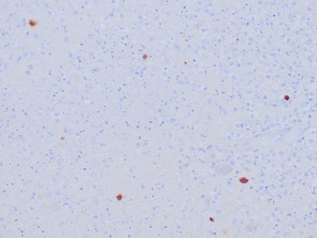 Immunohistochemistry of Herpes Simplex Virus Type I antibody in human HSV-infected tissue. FFPE human HSV-infected sections were subjected to heat-induced epitope retrieval by boiling in pH 9, 10 mM Tris with 1 mM EDTA for 20 minutes followed by cooling prior to staining. The recombinant rabbit monoclonal Herpes Simplex Virus Type I antibody clone HSVI/8375R was used as the detecting antibody. HRP-DAB brown staining is observed in scattered infected cells, with signal localized predominantly to the nucleus and cytoplasm of positive cells, while surrounding tissue shows minimal background staining. The staining pattern is consistent with Herpes simplex virus type 1 antigen expression in infected human tissue.