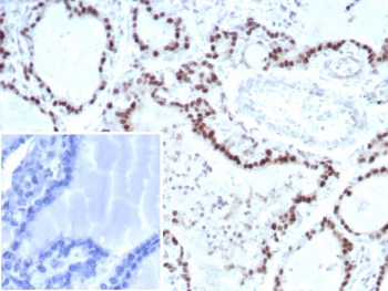 Transcription Factor E3 Antibody for IHC. Immunohistochemistry analysis of FFPE human thyroid tissue demonstrates strong nuclear HRP-DAB brown staining consistent with TFE3 (Transcription factor E3) localization in cell nuclei. Nuclear staining is observed in thyroid epithelial cells, reflecting the expected localization of this transcription factor within the nucleus where it regulates gene expression. Hematoxylin counterstain marks nuclei in blue. The recombinant rabbit monoclonal antibody clone TFE3/8663R was applied at 2 ug/ml to detect nuclear TFE3 protein in thyroid tissue. Inset: PBS was used in place of the primary antibody as a secondary antibody negative control. Heat-induced epitope retrieval was performed by boiling tissue sections in pH 9 10mM Tris with 1mM EDTA for 20 minutes followed by cooling prior to staining.