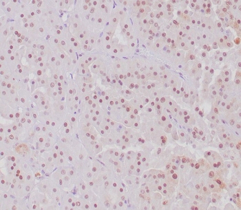 TFE3 Antibody for Immunohistochemistry. Immunohistochemistry analysis of FFPE human MiT translocation renal cell carcinoma tissue demonstrates strong nuclear HRP-DAB brown staining consistent with TFE3 (Transcription factor E3) localization in tumor cell nuclei. Nuclear staining is observed in tumor cells, reflecting the characteristic TFE3 IHC staining pattern associated with MiT family translocation renal cell carcinoma. Hematoxylin counterstain marks nuclei in blue. The recombinant rabbit monoclonal antibody clone TFE3/6849R was used at 2 ug/ml to detect nuclear TFE3 protein in tumor tissue. Heat-induced epitope retrieval was performed by boiling tissue sections in pH 9 10mM Tris with 1mM EDTA for 20 minutes followed by cooling prior to staining.