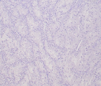 TFE3 Antibody for Immunohistochemistry. Negative control immunohistochemistry analysis of FFPE human clear cell renal cell carcinoma tissue using the recombinant rabbit monoclonal TFE3 antibody clone TFE3/6849R shows absence of nuclear HRP-DAB brown staining in tumor cells, confirming lack of detectable TFE3 protein in this tissue type. Clear cell RCC typically lacks TFE3 overexpression associated with MiT family translocation tumors, and the absence of nuclear staining supports assay specificity. Hematoxylin counterstain marks nuclei in blue. The recombinant rabbit monoclonal antibody clone TFE3/6849R was used at 2 ug/ml. Heat-induced epitope retrieval was performed by boiling tissue sections in pH 9 10mM Tris with 1mM EDTA for 20 minutes followed by cooling prior to staining.