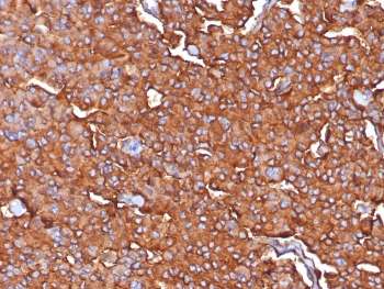 Synaptophysin Antibody Rabbit Monoclonal Clone SYP/7976R. Immunohistochemistry analysis of FFPE human adrenal tissue demonstrates strong cytoplasmic HRP-DAB brown staining in adrenal medullary neuroendocrine cells, consistent with Synaptophysin (SYP) localization in secretory vesicles. The staining pattern highlights clusters of neuroendocrine cells within the adrenal medulla, while surrounding cortical tissue shows minimal signal. Hematoxylin counterstain marks nuclei in blue. The rabbit monoclonal Synaptophysin antibody clone SYP/7976R was used to detect synaptic vesicle protein expression in human adrenal tissue. Heat-induced epitope retrieval was performed by boiling tissue sections in pH 9 10mM Tris with 1mM EDTA for 20 minutes followed by cooling prior to staining.