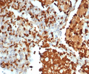 S100G Antibody Lung Tissue IHC. Immunohistochemistry analysis of S100 calcium binding protein G S100G expression in FFPE human lung tissue using S100G antibody clone S100G/7462. Cytoplasmic staining is observed in epithelial cell populations, consistent with the role of Calbindin D9K in calcium transport and absorption, while surrounding stromal cells show minimal signal. HIER: boil tissue sections in pH 9 10mM Tris with 1mM EDTA for 20 min and allow to cool before testing.