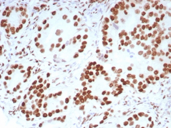Androgen Receptor Antibody Rabbit Monoclonal DHTR/8698R immunohistochemistry of human prostate carcinoma. Formalin-fixed, paraffin-embedded human prostate carcinoma tissue stained with the rabbit monoclonal Androgen Receptor Antibody DHTR/8698R shows strong nuclear HRP-DAB brown chromogenic staining in malignant glandular epithelial cells, consistent with androgen receptor expression and the expected nuclear localization of this steroid hormone receptor transcription factor. Surrounding stromal cells show minimal staining, highlighting the predominance of AR-positive tumor epithelial cells within the prostate carcinoma. Heat-induced epitope retrieval was performed by boiling tissue sections in pH 9 10mM Tris with 1mM EDTA for 20 min followed by cooling prior to antibody incubation.