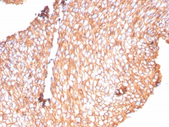 Uroplakin 1B Antibody immunohistochemistry analysis of Uroplakin 1B / UPK1B antibody in human bladder carcinoma tissue using clone UPK1B/9258R. FFPE sections demonstrate strong HRP-DAB brown membranous staining in tumor epithelial cells with clear luminal surface accentuation and polarized cell border definition, consistent with apical membrane localization in urothelial cells. This Urothelial Apical Surface Protein Antibody highlights the characteristic luminal-facing distribution of UPK1B within urothelial tumor epithelium. HIER: boil tissue sections in pH 9 10mM Tris with 1mM EDTA for 20 minutes followed by cooling prior to staining.
