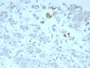 IL-6 Antibody Human Adrenal Gland Tissue IHC. Immunohistochemical staining of FFPE human adrenal gland tissue using IL-6 Antibody / Interleukin-6 Antibody (clone IL6/8713) demonstrates focal cytoplasmic HRP-DAB brown staining within scattered adrenal cellular populations. The observed staining pattern is consistent with expression of IL6, a multifunctional cytokine that regulates inflammatory signaling, immune cell communication, and tissue stress responses. Although staining is limited to discrete cell populations, the results support the presence of IL6-associated signaling activity within the adrenal microenvironment and demonstrate the utility of this antibody for studies of cytokine biology, endocrine-immune interactions, and inflammation-associated tissue responses. HIER: boil tissue sections in pH 9 10mM Tris with 1mM EDTA for 20 min and allow to cool before testing.