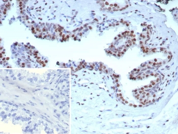 AR-V7 Antibody Recombinant Rabbit MAb (clone DHTR/9119R) detects androgen receptor variant 7 in immunohistochemistry analysis of formalin-fixed, paraffin-embedded human prostate carcinoma tissue. Distinct nuclear HRP-DAB staining is observed in tumor epithelial cells, consistent with the nuclear localization of the AR-V7 transcription factor, while surrounding stromal cells show minimal signal. The inset panel shows the negative control in which PBS was used in place of the primary antibody, confirming staining specificity. Antigen retrieval was performed by boiling tissue sections in 10 mM Tris with 1 mM EDTA, pH 9, for 20 minutes followed by cooling prior to antibody incubation.