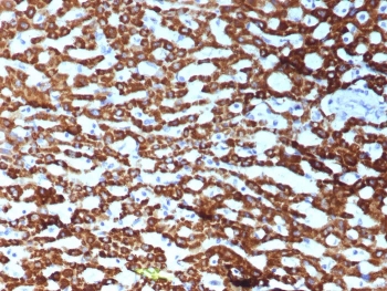 Carbamoyl phosphate synthetase 1 Antibody Hepatocellular Carcinoma IHC. Immunohistochemistry staining of FFPE human hepatocellular carcinoma tissue with recombinant Carbamoyl phosphate synthetase 1 antibody (clone CPS1/9151R). HIER: boil tissue sections in pH 9 10mM Tris with 1mM EDTA for 20 min and allow to cool before testing.