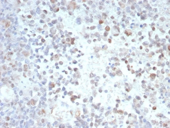 Opa-interacting Protein 4 Antibody Tumor IHC. Immunohistochemistry analysis of FFPE human tumor tissue stained with Opa-interacting Protein 4 Antibody / Tumor Antigen clone PRAME/9189. Tumor cell populations demonstrate variable nuclear HRP-DAB brown staining consistent with expression of Opa-interacting protein 4 / PRAME, a cancer-testis antigen associated with tumor-associated immune signaling and transcriptional regulation pathways commonly elevated in malignant tissues.