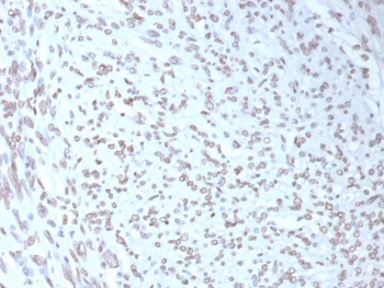 IHC staining of FFPE human liposarcoma tissue with MDM2 antibody (clone MDM2/7943). HIER: boil tissue sections in pH 9 10mM Tris with 1mM EDTA for 20 min and allow to cool before testing.