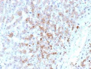 AKR1C1 Antibody Hepatocellular Carcinoma IHC. Immunohistochemistry analysis of FFPE human hepatocellular carcinoma tissue using AKR1C1 Antibody (clone AKR1C1/9063) shows cytoplasmic staining in tumor cells, consistent with AKR1C1 / Aldo-keto reductase family 1 member C1 localization as a cytosolic enzyme. The staining is heterogeneous across the tumor field, with variable intensity reflecting differences in metabolic activity among tumor cells. Surrounding non-tumor regions display comparatively lower signal. Hematoxylin counterstain provides nuclear contrast and tissue architecture. HIER: boil FFPE tissue sections in pH 9 10 mM Tris with 1 mM EDTA for 20 min and allow to cool before testing.