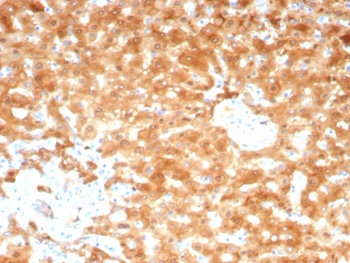 IHC staining of FFPE human hepatocellular carcinoma tissue with AKR1C1 antibody (clone AKR1C1/9070). HIER: boil tissue sections in pH 9 10mM Tris with 1mM EDTA for 20 min and allow to cool before testing.