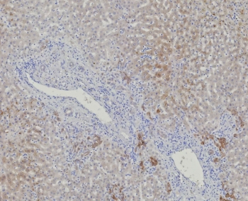 IHC staining of FFPE human hepatocellular carcinoma tissue with AKR1C1 antibody (clone AKR1C1/9317). HIER: boil tissue sections in pH 9 10mM Tris with 1mM EDTA for 20 min and allow to cool before testing.