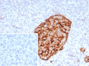 Immunohistochemistry of GAD2 Antibody Recombinant Mouse MAb rGAD2/9382 in human pancreas. Formalin-fixed, paraffin-embedded human pancreatic tissue demonstrates strong HRP-DAB brown cytoplasmic staining in islet cells, consistent with Glutamate decarboxylase 2 expression in pancreatic neuroendocrine cells. Surrounding exocrine acinar tissue shows minimal staining. The inset shows PBS used in place of the primary antibody as a negative control. Heat-induced epitope retrieval was performed by boiling tissue sections in pH 9 10mM Tris with 1mM EDTA for 20 min followed by cooling prior to antibody incubation.
