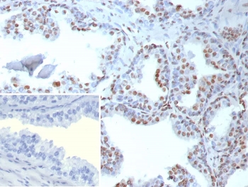 TDP43 Antibody Rabbit Monoclonal Prostate Immunohistochemistry. IHC of TDP43 antibody in human prostate tissue. FFPE human prostate shows strong nuclear HRP-DAB brown staining within glandular epithelial cells, consistent with the known nuclear localization of TAR DNA binding protein 43 / TARDBP. Clone TARDP/9299R was used as a rabbit monoclonal antibody for detection. The inset shows PBS in place of primary antibody as a negative control with absence of specific staining. Heat-induced epitope retrieval was performed by boiling tissue sections in pH 9, 10 mM Tris with 1 mM EDTA for 20 minutes followed by cooling prior to staining.