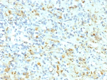 Anaplastic Lymphoma Kinase Antibody Ewing Sarcoma IHC. Immunohistochemistry staining of FFPE human Ewing sarcoma tissue using recombinant monoclonal clone ALK1/9660R demonstrates scattered granular cytoplasmic HRP-DAB brown staining within malignant small round tumor cells embedded in fibrous stromal tissue. The observed staining profile supports detection of Anaplastic Lymphoma Kinase / ALK-associated protein expression in sarcoma-derived neoplastic cellular populations and reinforces the role of ALK pathway signaling in oncogenic kinase biology research. HIER: boil tissue sections in pH 9 10mM Tris with 1mM EDTA for 20 min and allow to cool before testing.