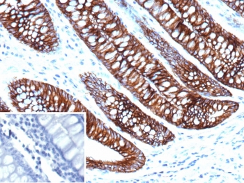 Immunohistochemistry of Cadherin 17 antibody in human colon tissue. The mouse monoclonal clone CDH17/2612 demonstrates strong membranous HRP-DAB brown staining along the lateral borders of colonic epithelial cells, consistent with Cadherin 17 localization in intestinal epithelium. Staining highlights well-organized glandular structures with preserved apical-basal polarity, while surrounding stromal tissue shows minimal background signal. The negative control inset, using PBS in place of the primary antibody, shows no specific staining. Heat-induced epitope retrieval was performed by boiling tissue sections in pH 9 10mM Tris with 1mM EDTA for 20 minutes followed by cooling prior to incubation.