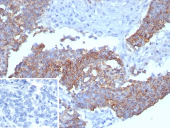 Immunohistochemistry of Recombinant MSLN Antibody in human ovarian carcinoma. Formalin-fixed, paraffin-embedded human ovarian carcinoma shows membranous and cytoplasmic staining of tumor epithelial cells. Clone MSLN/8331R was used following heat-induced epitope retrieval by boiling tissue sections in pH 9 10mM Tris with 1mM EDTA for 20 minutes and cooling at room temperature. The inset shows PBS in place of primary antibody as a secondary-only negative control.
