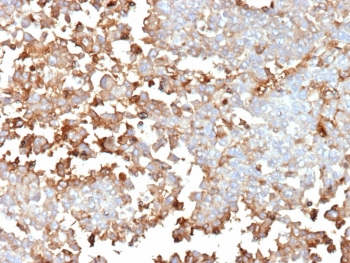 Immunohistochemistry of Periostin antibody mouse monoclonal in human adrenal gland tissue. Formalin-fixed, paraffin-embedded human adrenal gland was stained with mouse monoclonal Periostin antibody (clone POSTN/4096) following heat-induced epitope retrieval by boiling in pH 9 10 mM Tris with 1 mM EDTA for 20 minutes and cooling prior to testing. Brown chromogenic signal is observed predominantly within stromal and extracellular matrix regions surrounding adrenal cortical cell clusters, consistent with the secreted and matrix-associated localization of Periostin, while most adrenal parenchymal nuclei remain negative.