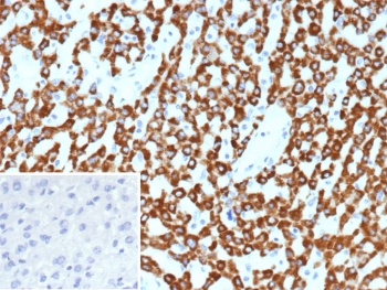 CPS1 Antibody Hepatocellular Carcinoma IHC. Immunohistochemistry of Carbamoyl Phosphate Synthetase 1 / CPS1 in FFPE human hepatocellular carcinoma tissue using mouse monoclonal CPS1 antibody, clone CPS1/9859. Strong HRP-DAB brown cytoplasmic staining highlights tumor cells of hepatocellular origin, consistent with retained hepatocyte differentiation and supporting its use as a hepatocyte-associated marker, while nuclei are counterstained blue. Inset: PBS was used in place of primary antibody as a negative control to confirm specificity of staining. Heat induced epitope retrieval was performed by boiling tissue sections in pH 9 10 mM Tris with 1 mM EDTA for 20 min followed by cooling prior to staining.