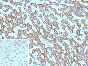 Carbamoyl phosphate synthetase 1 Antibody Hepatocellular Carcinoma Immunohistochemistry. IHC testing of FFPE human hepatocellular carcinoma tissue with Carbamoyl phosphate synthetase 1 antibody (clone CPS1/9865). Inset: PBS used in place of primary Ab (secondary Ab negative control). HIER: boil tissue sections in pH 9 10mM Tris with 1mM EDTA for 20 min and allow to cool before testing.