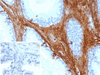 Decorin Antibody Prostate Carcinoma Immunohistochemistry. IHC staining of FFPE human prostate carcinoma tissue with microarray validated Decorin antibody (clone DCN/3521). Inset: PBS used in place of primary Ab (secondary Ab negative control). HIER: boil tissue sections in pH 9 10mM Tris with 1mM EDTA for 20 min and allow to cool before testing.