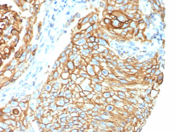 Tissue Factor Antibody Lung Carcinoma IHC. Immunohistochemistry analysis of FFPE human lung carcinoma tissue using Tissue Factor antibody clone CD142/9195. Tumor epithelial cells demonstrate strong membranous and cytoplasmic HRP-DAB brown staining consistent with the surface-associated localization of Tissue Factor / F3 / CD142 in coagulation pathway activation, inflammatory signaling, angiogenic regulation, and tumor-associated procoagulant activity within pulmonary carcinoma tissue. Nuclei are counterstained blue. Heat-induced epitope retrieval was performed by boiling tissue sections in pH9 10 mM Tris with 1 mM EDTA for 20 minutes followed by cooling prior to staining.