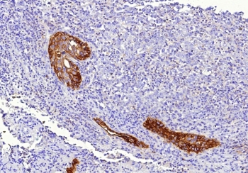 CD142 Antibody Human Lung Tissue IHC. Immunohistochemistry analysis of FFPE human lung tissue using CD142 antibody clone CD142/9196. Bronchial and vascular-associated epithelial structures demonstrate strong membranous and cytoplasmic HRP-DAB brown staining consistent with the surface-associated localization of CD142 / Tissue Factor in coagulation pathway activation, inflammatory signaling, and vascular injury-response pathways within pulmonary tissue. Surrounding stromal and lymphoid regions show comparatively lower staining intensity. Nuclei are counterstained blue. Heat-induced epitope retrieval was performed by boiling tissue sections in pH9 10 mM Tris with 1 mM EDTA for 20 minutes followed by cooling prior to staining.