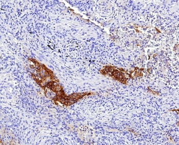 CD142 Antibody Lung IHC. Immunohistochemistry analysis of FFPE human lung tissue using CD142 antibody clone CD142/9196. Bronchial epithelial structures demonstrate prominent membranous and cytoplasmic HRP-DAB brown staining consistent with the surface-associated localization of CD142 / Tissue Factor in coagulation signaling, inflammatory activation, and vascular injury-response pathways within pulmonary tissue. Surrounding stromal regions display comparatively reduced staining intensity. Nuclei are counterstained blue. Heat-induced epitope retrieval was performed by boiling tissue sections in pH9 10 mM Tris with 1 mM EDTA for 20 minutes followed by cooling prior to staining.