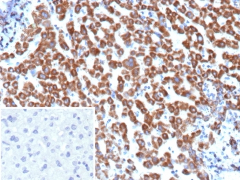 Angiopoietin 1 Antibody Hepatocellular Carcinoma IHC. Immunohistochemistry staining of FFPE human hepatocellular carcinoma tissue using Angiopoietin 1 Antibody demonstrates strong cytoplasmic HRP-DAB brown staining throughout tumor cell populations. The staining pattern is consistent with expression of Angiopoietin 1 / ANGPT1, a vascular growth factor that regulates TEK/TIE2 signaling, vascular stability, and angiogenic remodeling. Clone ANGPT1/3651 highlights robust ANGPT1 expression within neoplastic hepatocytes, supporting the established involvement of angiopoietin signaling pathways in tumor vascularization and tumor microenvironment regulation. Inset: PBS was used in place of the primary antibody as a secondary antibody negative control. HIER: boil tissue sections in pH 9 10mM Tris with 1mM EDTA for 20 min and allow to cool before testing.