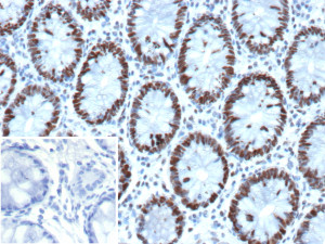 GTBP Antibody MSH6/13194R in Human Colon IHC. Immunohistochemistry testing of GTBP Antibody / G/T mismatch-binding protein / MSH6, clone MSH6/13194R, in FFPE human colon tissue. Strong nuclear staining is observed in colonic epithelial cells, consistent with the nuclear localization of GTBP/MSH6. The inset shows a secondary-only negative control in which PBS was substituted for the primary antibody, demonstrating minimal background staining under the tested conditions.