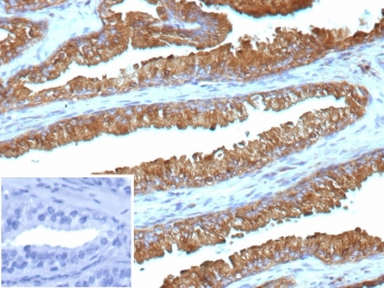 IHC staining of FFPE human prostate cancer tissue with IDH1-R132G antibody (clone IDH1.R132G/13054R). Inset: PBS used in place of primary Ab (secondary Ab negative control). HIER: boil tissue sections in pH 9 10mM Tris with 1mM EDTA for 20 min and allow to cool before testing.