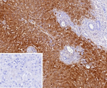 Liver Arginase Antibody (clone ARG1/9447) immunohistochemistry of human hepatocellular carcinoma. Formalin-fixed, paraffin-embedded human hepatocellular carcinoma tissue stained with the mouse monoclonal Liver Arginase Antibody (clone ARG1/9447) shows strong cytoplasmic HRP-DAB brown chromogenic staining in malignant hepatocyte-derived tumor cells, consistent with the known hepatic expression and cytosolic localization of Arginase-1 (ARG1), a key urea cycle enzyme involved in arginine metabolism. The inset shows a PBS-only negative control processed without primary antibody, demonstrating minimal non-specific background staining. Heat-induced epitope retrieval was performed by boiling tissue sections in pH 9 10mM Tris with 1mM EDTA for 20 min followed by cooling prior to antibody incubation.