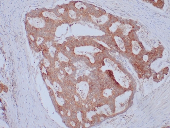 EpCAM Antibody Ber-EP4 IHC. Immunohistochemistry staining of FFPE human colon adenocarcinoma with EpCAM antibody (clone Ber-EP4). HIER: boil tissue sections in pH 9 10mM Tris with 1mM EDTA for 10-20 min and allow to cool before testing.