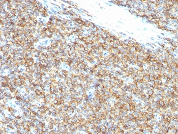 IHC staining of FFPE human Ewing sarcoma tissue with CD99 antibody (clone 12E7). Membranous brown staining is observed in tumor cells, consistent with strong CD99 surface expression characteristic of Ewing sarcoma, while surrounding stromal elements show minimal to no staining. HIER was performed by boiling tissue sections in pH 9 10mM Tris with 1mM EDTA for 20 min followed by cooling prior to staining.