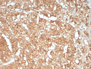 IHC staining of FFPE human adrenal gland tissue with ATM antibody (clone ATM/9472). Inset: PBS used in place of primary Ab (secondary Ab negative control). HIER: boil tissue sections in pH 9 10mM Tris with 1mM EDTA for 20 min and allow to cool before testing.