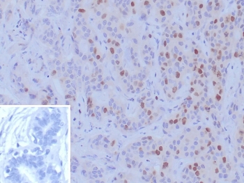BRCA1 Antibody Human Breast Carcinoma Tissue IHC. Immunohistochemistry staining of FFPE human breast carcinoma tissue with BRCA1 antibody (clone BRCA1/9797R). Inset: PBS used in place of primary Ab (secondary Ab negative control). HIER: boil tissue sections in pH 9 10mM Tris with 1mM EDTA for 20 min and allow to cool before testing.