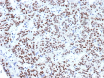 IHC staining of FFPE human thyroid tissue with NKX2.1 antibody (clone NX2.1/9033). HIER: boil tissue sections in pH 9 10mM Tris with 1mM EDTA for 20 min and allow to cool before testing.