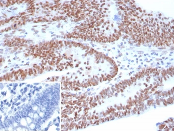 Immunohistochemistry analysis of Tumor Protein 53 antibody in human ovarian carcinoma tissue (clone TP53/8183R). FFPE ovarian carcinoma sections demonstrate strong HRP-DAB brown nuclear staining in the majority of tumor epithelial cells, consistent with accumulation of p53 protein in neoplastic nuclei. The staining pattern is predominantly nuclear, with minimal cytoplasmic background and low stromal signal. This nuclear localization aligns with the role of Tumor protein 53 as a transcription factor regulating cell cycle and DNA damage responses. The inset image shows the PBS secondary-only negative control, confirming absence of specific staining in the control section. Heat induced epitope retrieval was performed by boiling tissue sections in pH 9 10mM Tris with 1mM EDTA for 20 minutes followed by cooling prior to primary antibody incubation.