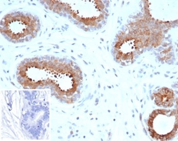 IHC staining of FFPE human breast carcinoma tissue with BAP1 antibody (clone BAP1/9795R). Inset: PBS used in place of primary Ab (secondary Ab negative control). HIER: boil tissue sections in pH 9 10mM Tris with 1mM EDTA for 20 min and allow to cool before testing.