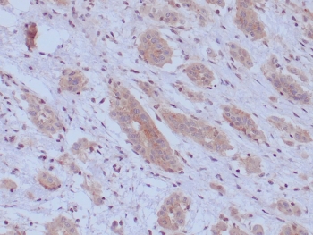 IHC staining of FFPE human mesothelioma tissue with BAP1 antibody (clone BAP1/9795R). Inset: PBS used in place of primary Ab (secondary Ab negative control). HIER: boil tissue sections in pH 9 10mM Tris with 1mM EDTA for 20 min and allow to cool before testing.