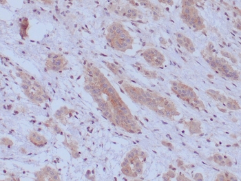 IHC staining of FFPE human mesothelioma tissue with BAP1 antibody (clone BAP1/13501R). Inset: PBS used in place of primary Ab (secondary Ab negative control). HIER: boil tissue sections in pH 9 10mM Tris with 1mM EDTA for 20 min and allow to cool before testing.