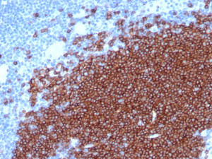 CD19 Antibody Human Lymph Node IHC. Immunohistochemistry analysis of FFPE human lymph node tissue using recombinant CD19 Antibody / B Cell Marker Antibody (clone CD19/4260R). Heat induced antigen retrieval was performed by boiling tissue sections in pH 9 Tris-EDTA buffer for 20 minutes prior to staining. Strong membranous staining is observed in B cell populations within lymphoid tissue, consistent with CD19 expression as a B lymphocyte surface marker. These results support the use of CD19 Antibody / B Cell Marker Antibody, a Protein Microarray Validated recombinant monoclonal antibody, for studying immune cell identification and B cell biology.