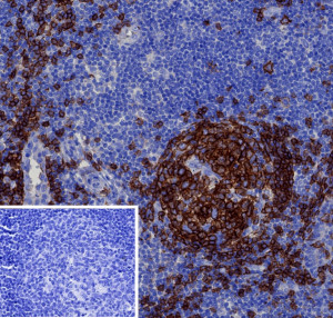 CD19 Antibody Human Tonsil IHC. Immunohistochemistry analysis of FFPE human tonsil tissue using recombinant CD19 Antibody / B Cell Marker Antibody (clone CD19/4260R). Heat induced antigen retrieval was performed by boiling tissue sections in pH 9 Tris-EDTA buffer for 20 minutes prior to staining. PBS was used in place of the primary antibody as a negative control (inset). Strong membranous staining is observed in B cell populations within lymphoid follicles, supporting the use of CD19 Antibody / B Cell Marker Antibody for studying B lymphocyte markers, immune cell identification and hematopoietic research pathways.