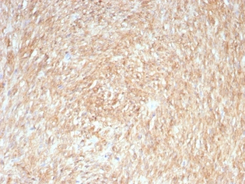 Immunohistochemistry analysis of ANO1 (TMEM16A) expression. ANO1 antibody (clone rDG1/8750) staining was performed on formalin-fixed, paraffin-embedded human gastrointestinal stromal tumor tissue, showing diffuse DAB-positive staining throughout tumor cells, consistent with ANO1 expression in GIST, with hematoxylin counterstaining. Heat-induced epitope retrieval was carried out by boiling tissue sections in Tris buffer (10 mM, pH 9.0) containing EDTA (1 mM) for 10-20 minutes, followed by cooling at room temperature for 20 minutes, and signal detection was achieved using an HRP-conjugated secondary antibody and DAB chromogen.