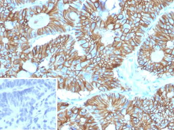 CDH17 Antibody Colon Adenocarcinoma IHC. Immunohistochemistry staining of FFPE human colon adenocarcinoma tissue using CDH17 Antibody / Liver-Intestine Cadherin Antibody (clone CDH17/2613) demonstrates strong membranous HRP-DAB brown staining within malignant gland-forming epithelial cells. The staining pattern is consistent with expression of Cadherin 17 (CDH17, LI-cadherin), a calcium-dependent cell adhesion molecule involved in epithelial organization, maintenance of tissue integrity, and regulation of cell-cell interactions within the gastrointestinal tract. Prominent membrane-associated staining highlights intestinal-type differentiation and preserved glandular architecture within the tumor. The inset image shows the negative control in which PBS was substituted for the primary antibody, demonstrating minimal background staining. HIER was performed by heating tissue sections in 10 mM Tris with 1 mM EDTA, pH 9.0, for 45 minutes at 95 C followed by cooling at room temperature for 20 minutes prior to immunostaining.