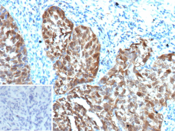 Immunohistochemistry of CDKN2A / p16INK4a in human cervix tissue. Formalin-fixed, paraffin-embedded human cervix tissue was stained with p16INK4a antibody (clone CDKN2A/13309R). Predominant nuclear and cytoplasmic staining is observed in tumor epithelial cells, with surrounding stromal cells showing minimal background signal. Inset shows PBS used in place of the primary antibody as a secondary antibody-only negative control. Staining of formalin-fixed tissues requires heating tissue sections in 10mM Tris with 1mM EDTA, pH 9.0, for 45 minutes at 95Â°C followed by cooling at room temperature for 20 minutes.