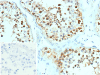 Immunohistochemistry analysis of formalin-fixed, paraffin-embedded human testis tissue using HSPH1 antibody (clone r58F12). Nuclear and cytoplasmic staining is observed in a subset of testicular cells, with granular signal present in both compartments and minimal background staining in surrounding stromal elements. Nuclei are counterstained in blue. Inset shows PBS substituted for the primary antibody as a secondary-only negative control. Heat-induced antigen retrieval was performed by heating tissue sections in 10 mM Tris with 1 mM EDTA, pH 9.0, for 45 minutes at 95Â°C, followed by cooling at room temperature for 20 minutes.