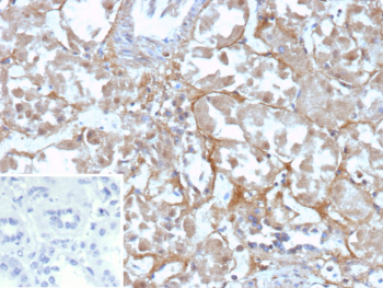Formalin-fixed, paraffin-embedded human renal cell carcinoma stained with recombinant OX2R/OX-2 receptor antibody (CD200R1/9919R). Tumor cells show predominantly cytoplasmic staining with variable membranous accentuation, while surrounding stromal elements show minimal signal. Inset: PBS instead of primary antibody; secondary-only negative control. Staining of formalin-fixed tissues requires heating tissue sections in 10mM Tris with 1mM EDTA, pH 9.0, for 45 min at 95oC followed by cooling at RT for 20 minutes.